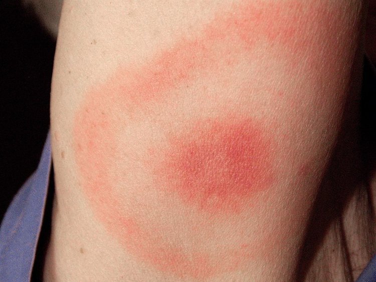 Lyme Disease Rash