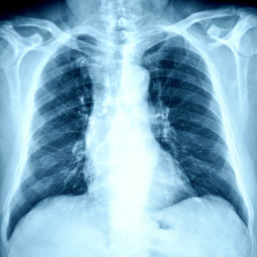 New Pneumonia Guidance: Testing, Treating, and Follow-up – SpringKlean ...